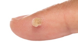 En vorte er en hudsygdom, som effektivt bekæmper Skincell Pro